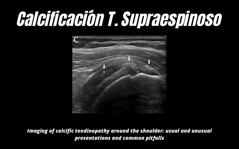 Calcificacion Supraespinoso Ecografia 5.png